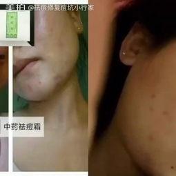火针祛痘视频,传统中医与现代科技的完美结合